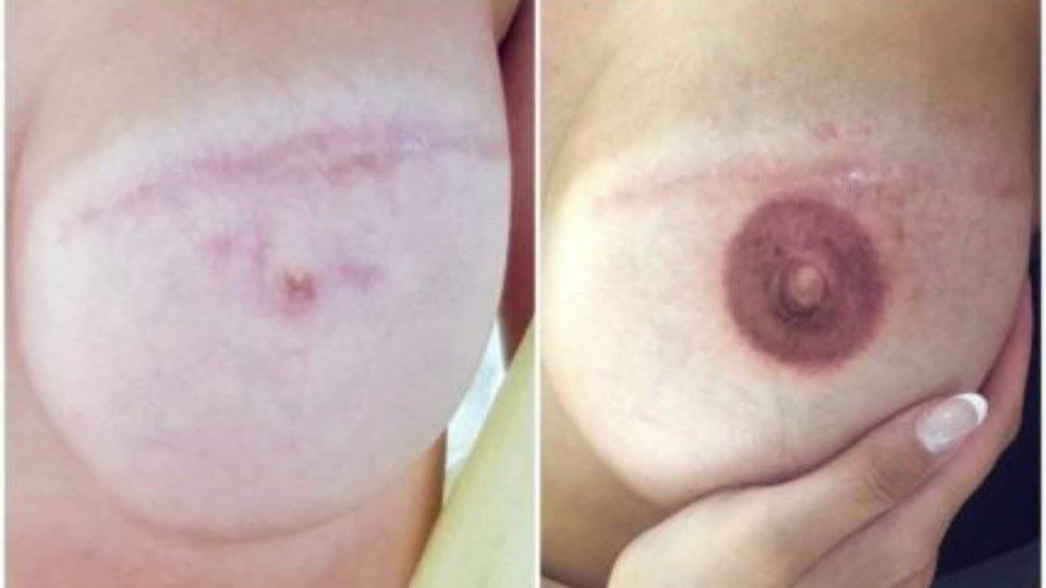 Paramedical Areola Nipple