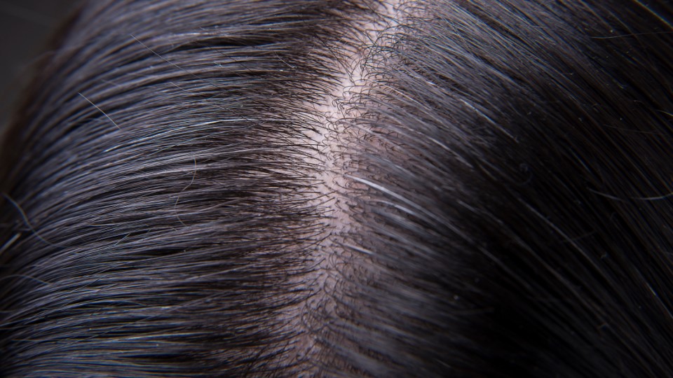 Scalp (2)