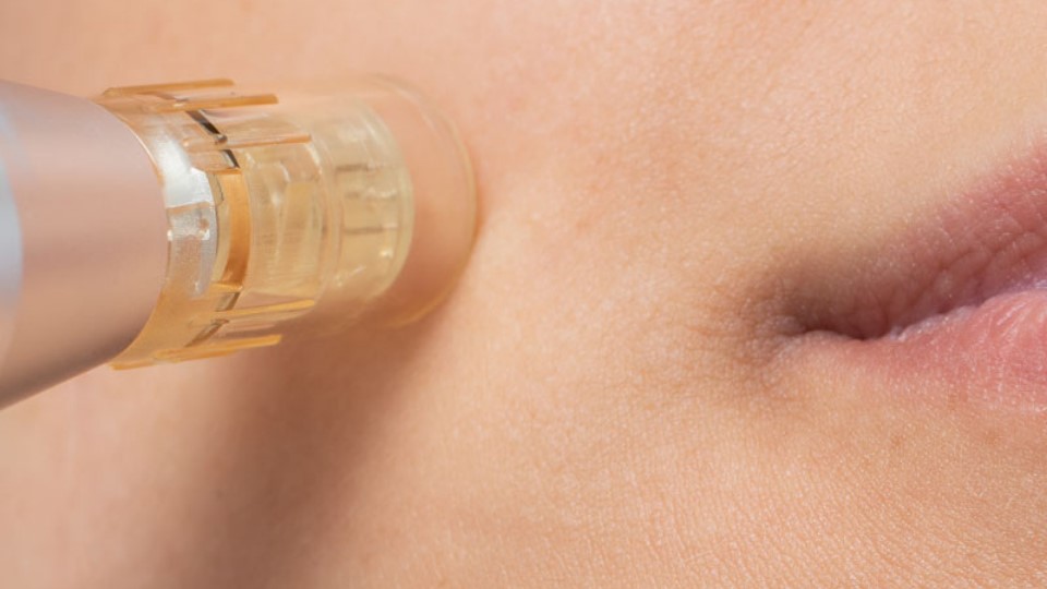 Skin Needling Face (1)