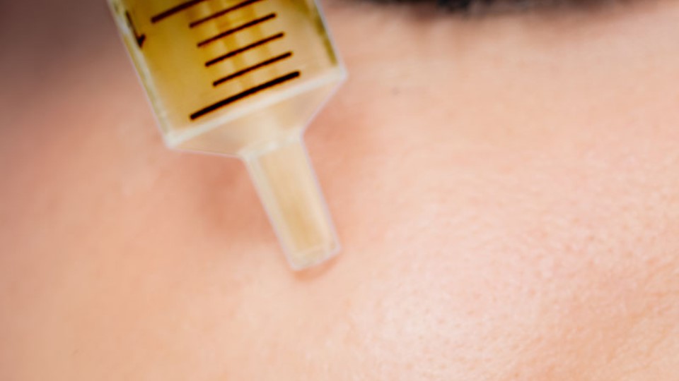 Skin Needling Face (2)